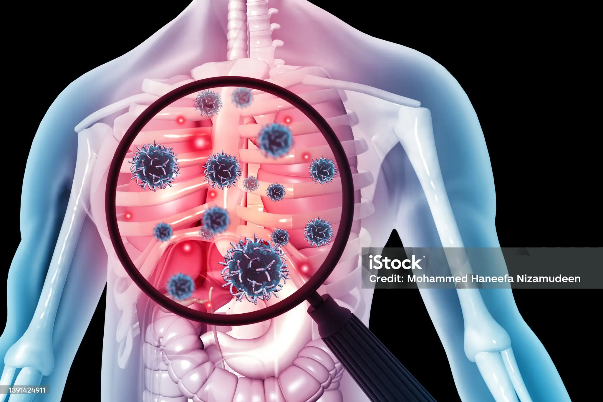 World Tuberculosis Day 2024