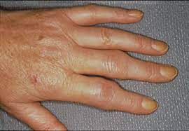 Rheumatoid arthritis