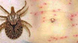 Scrub Typhus