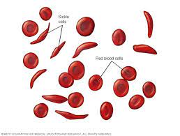 Sickle cell breakthrough